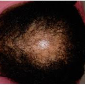 Alopecia Areata