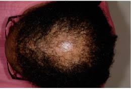 Alopecia Areata