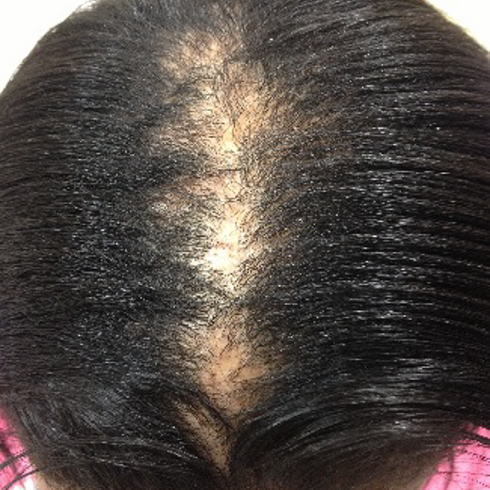 Androgenic (Andro-genetic) Alopecia