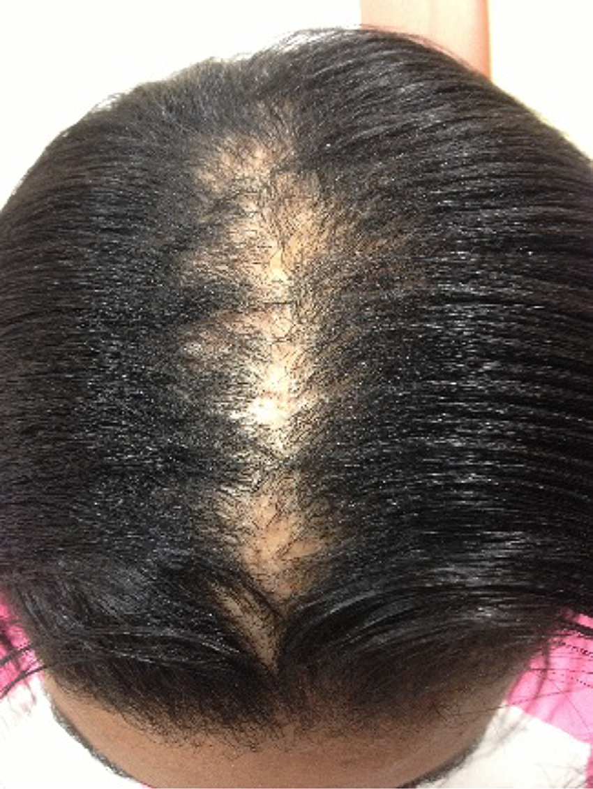 Androgenic (Andro-genetic) Alopecia