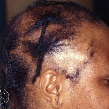 Traction Alopecia