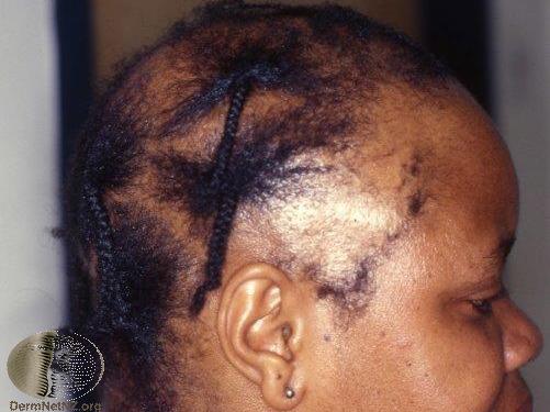 Traction Alopecia